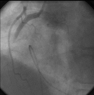 STEMI Combined with Acute Total Occlusion of RCA and LAD | tctmd.com