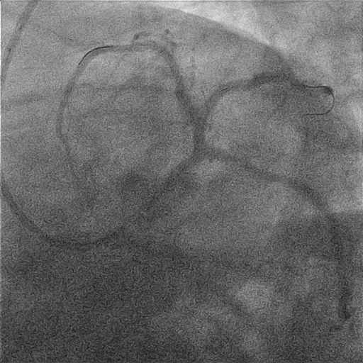 Treatment of LAD Coronary Aneurysm | tctmd.com