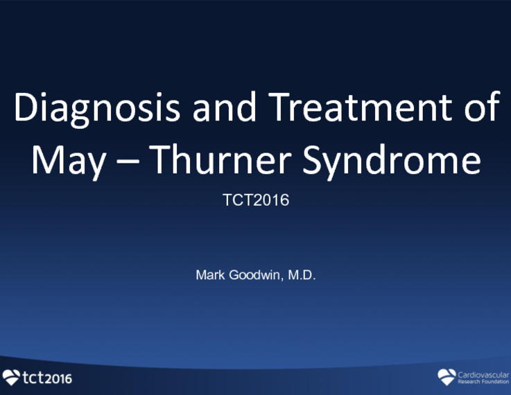 May-Thurner Syndrome: Causes, Symptoms & Treatment