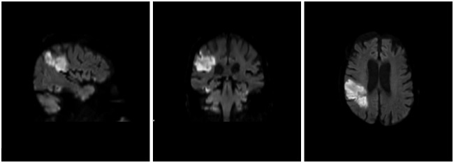 Sentinel Tavr Sentinel Cerebral Protection Device in TAVR ‘Promising’ but Trial ...