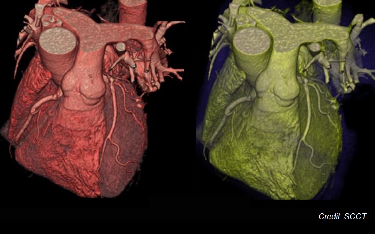 CT Heart Angiogram, PCI Treatment
