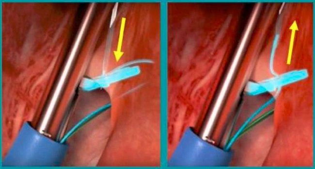 Novel Percutaneous Suture-Based Solution for PFO Closure Shows Promise ...