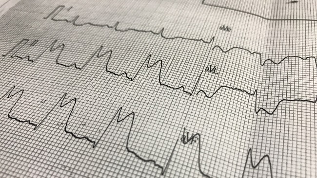 Multivessel PCI Improves Outcomes in STEMI Patients With Cardiogenic ...