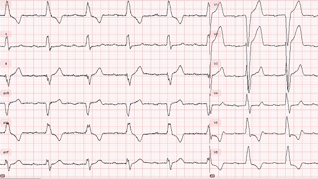 Half of TAVR Patients Develop Potentially Dangerous Conduction ...