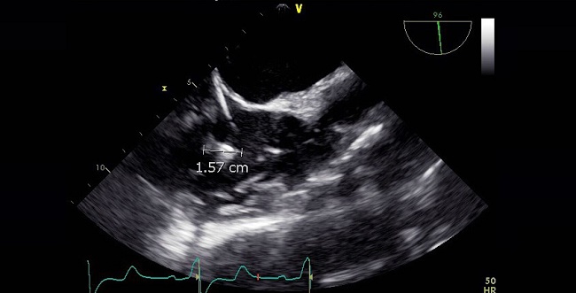 Incidental Thrombi on Device Leads Common, but Seemingly Innocuous ...