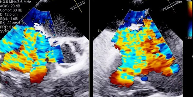 Pascal Transcatheter Device Safe, Improves Tricuspid Regurgitation ...
