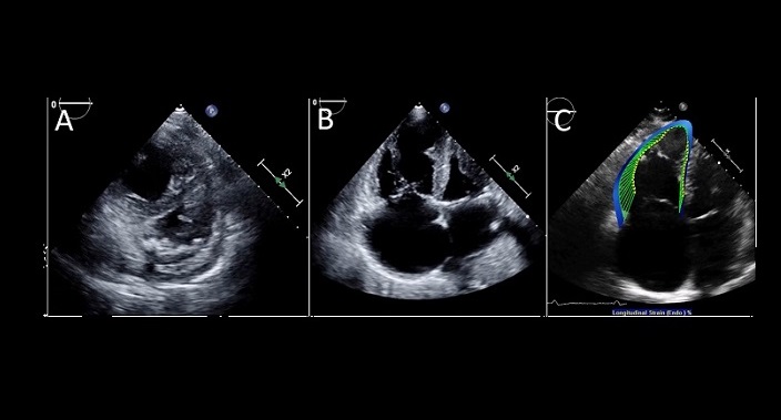 Right ventricular strain