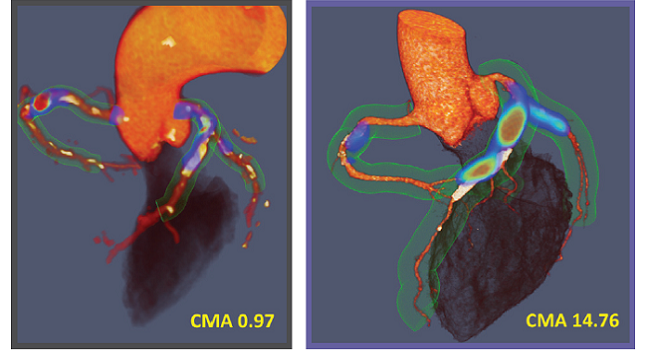 Sodium Fluoride PET Bests CT for Predicting MI in CAD Patients | tctmd.com