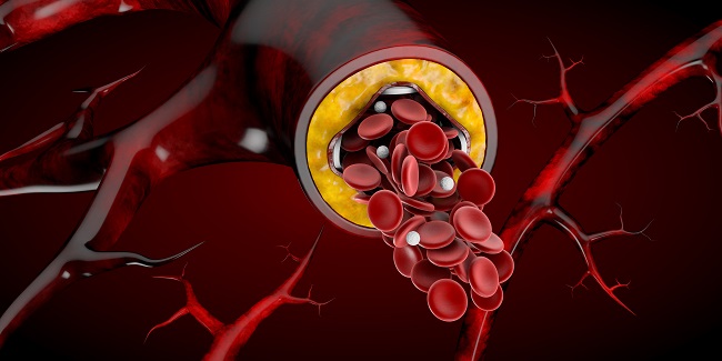 In-Stent Restenosis Accounts for 10% of All PCIs, National Analysis ...