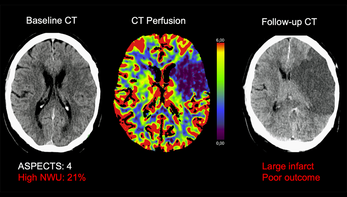 Mechanical Thrombectomy in Nighttime Hours: Is There a Difference