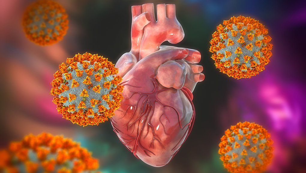 Small Study Hints at Mechanism for COVID-Related MI and Stroke - Vimarsana News