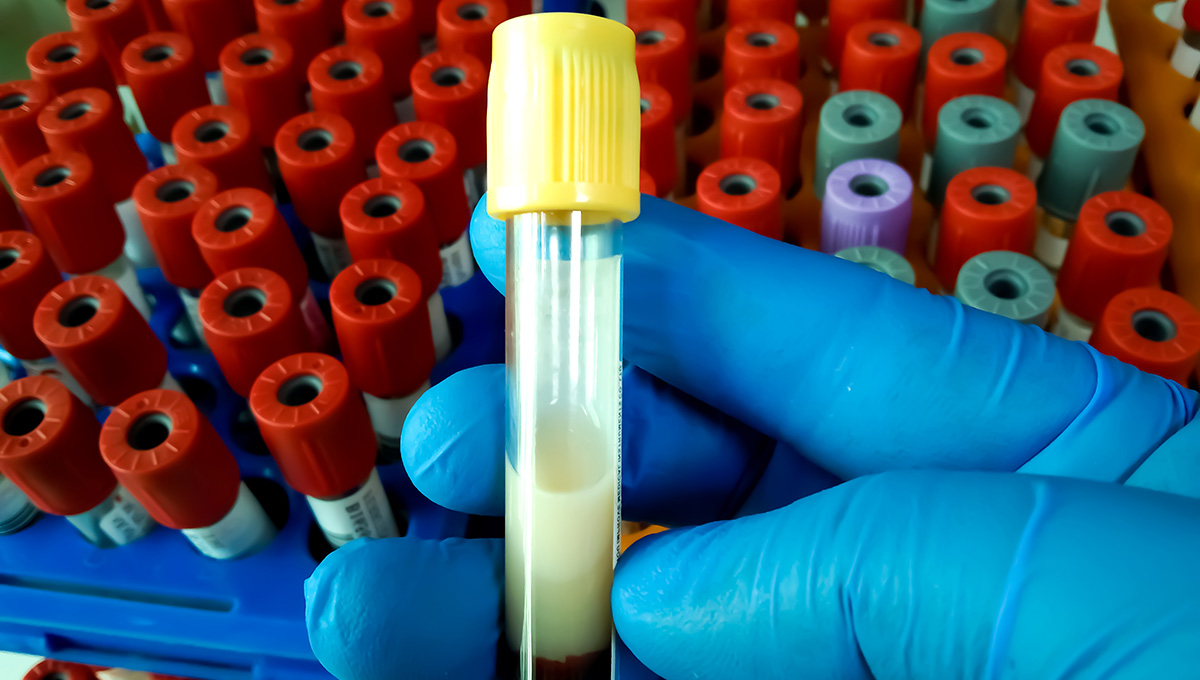 LIBerate-HR: Lerodalcibep Lowers LDL More Sharply Than Placebo Over 1 Year - Vimarsana News