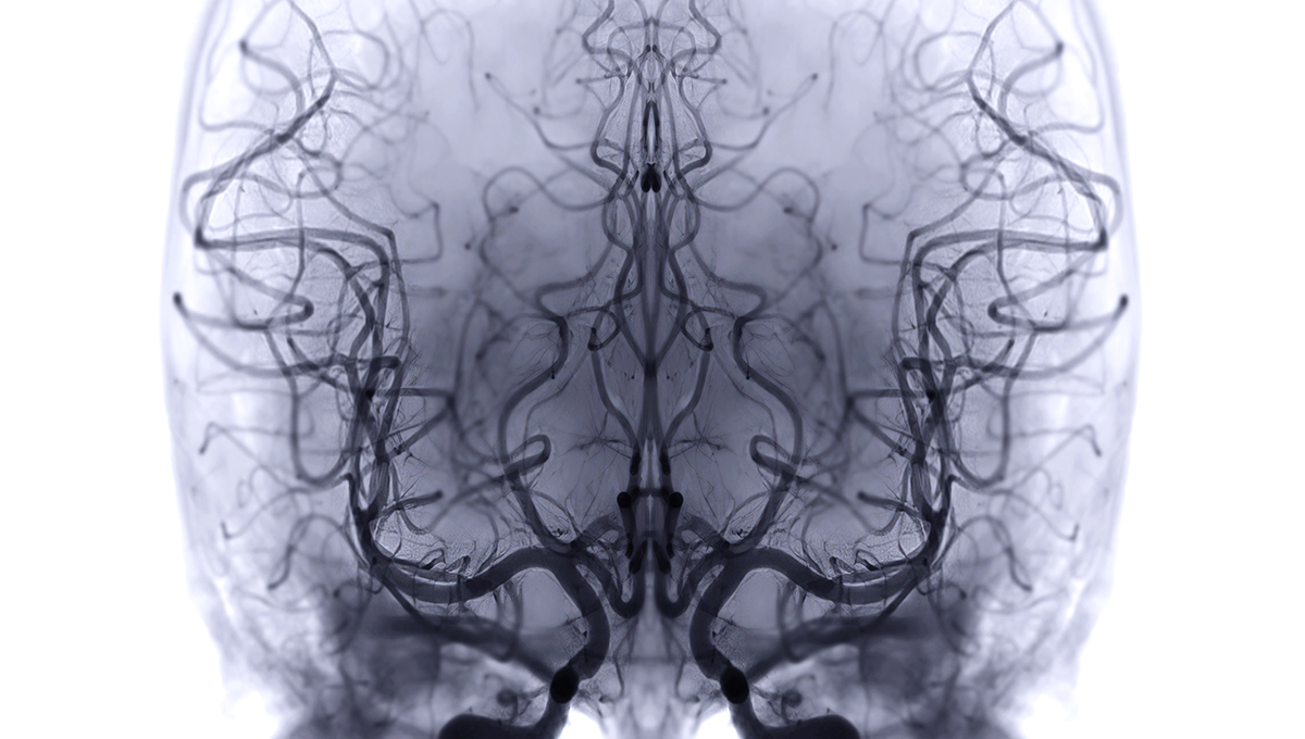 Lower Diagnostic Success With Transradial Cerebral Angiography