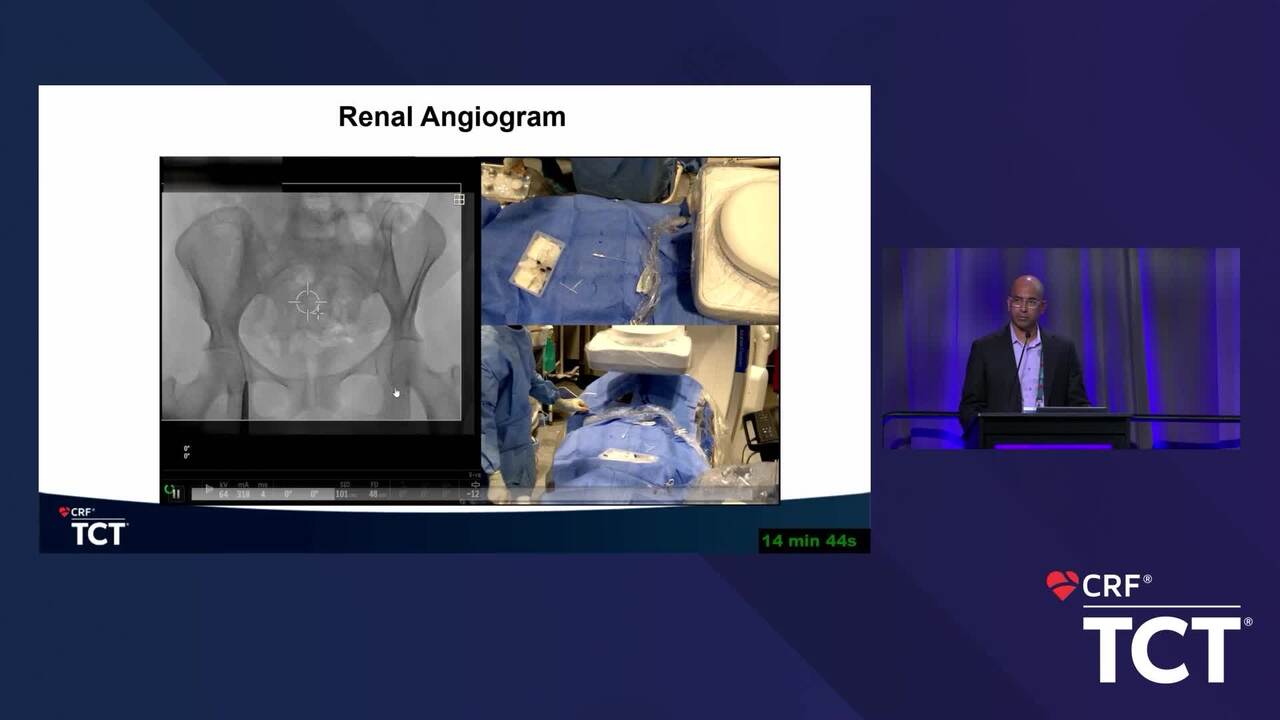 The Real Impact of Paradise™ Ultrasound RDN: Real Data. Real Durability. Real Difference