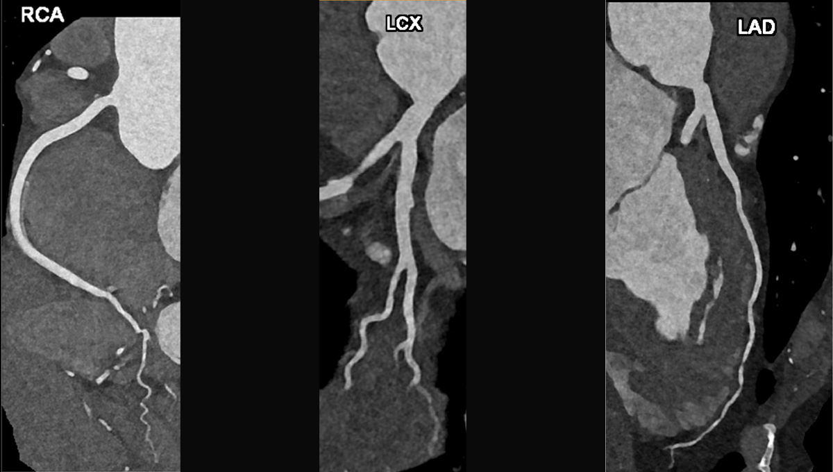 Single Heartbeat CCTA Acquisition Suffices in Many Young, Low-risk Patients