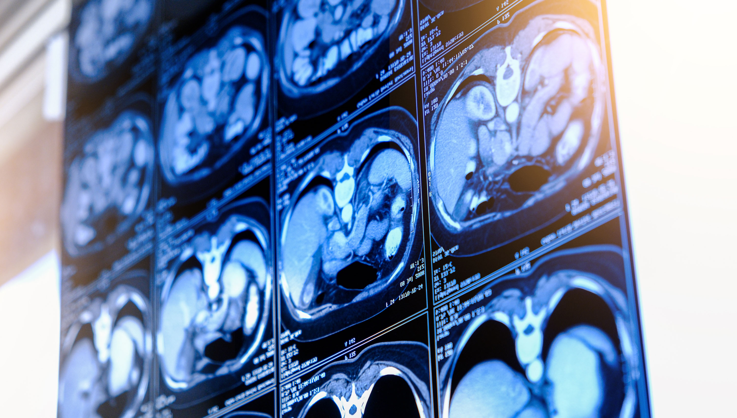 CAC Derived From Nongated CT Can Accurately Predict CV Risk