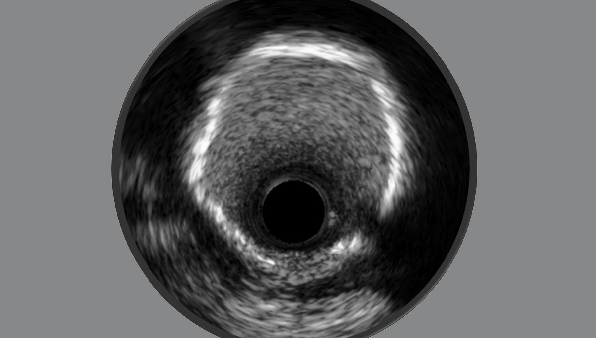 Quality-Improvement Initiative Spurs Imaging-Guided PCI Use