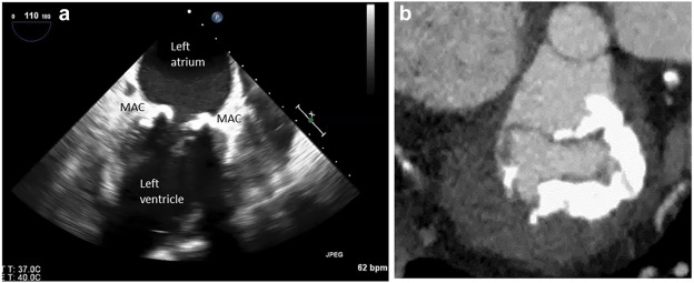 Mitral Annular Calcification: Understanding the Disease and Treatment Options