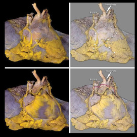 Pericardial Anatomy, Interventions and Therapeutics: A Contemporary Review