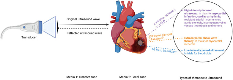 Role of Ultrasound-Based Therapies in Cardiovascular Diseases