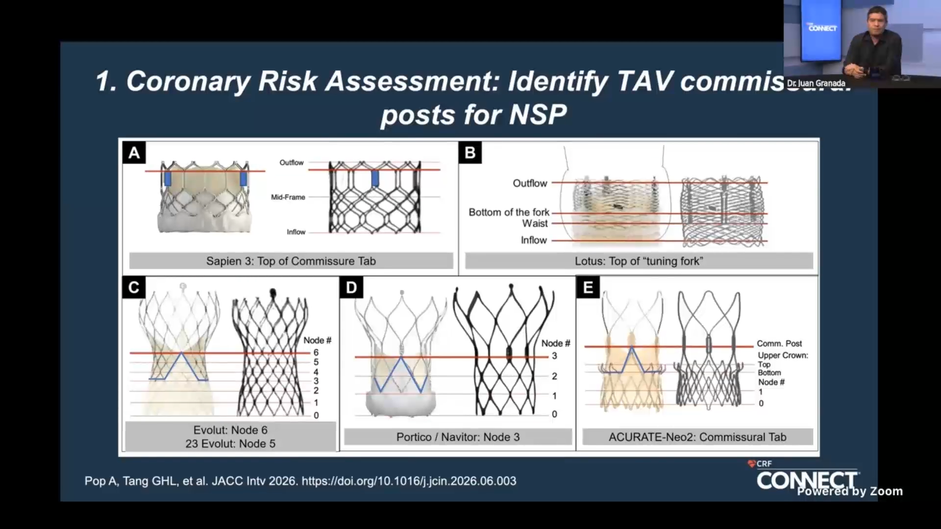 TAVR Masterclass: Aortic Valve-in-Valve Procedures with High Risk for Coronary Occlusion