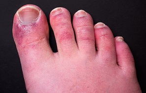 Chilblains COVID-19