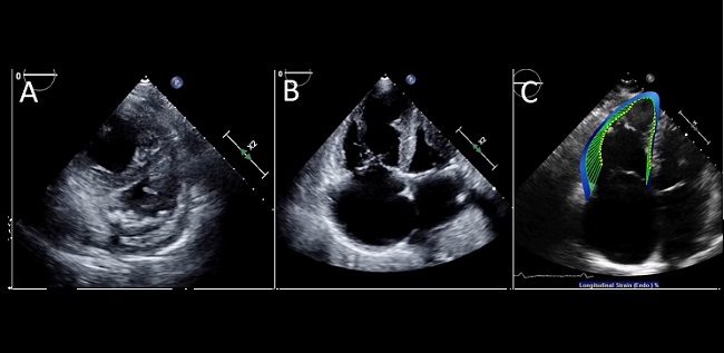 RV Strain a Prognostic Marker for Mortality in COVID-19