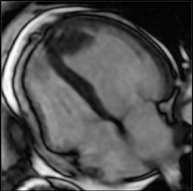 Cardiac mass on MRI (Photo Credit: Jiwon Kim, MD)