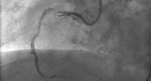 des best for in-stent restenosis, but dcbs also viable