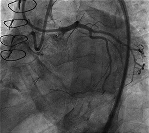 Figure 1. Initial dual injection