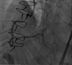 Figure 2. Angiography 2 months after initial balloon angioplasty