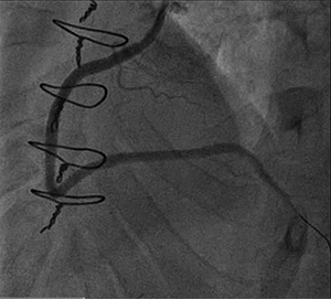 Figure 3. Final angiography after stenting