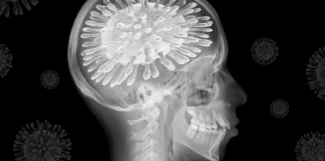 Ischemic Strokes More Severe, Deadlier in COVID-19