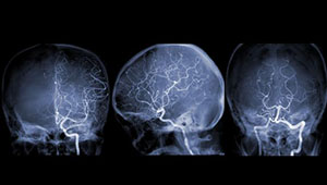Long-Awaited CREST-2 Results Bolster Stents for Asymptomatic Carotid Stenosis