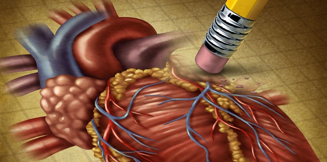 STEMI's