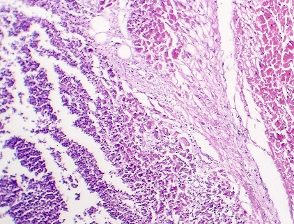 True Myocarditis Uncommon in COVID-19, Review Concludes