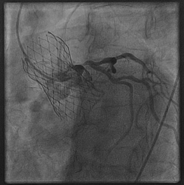 Angiogram image