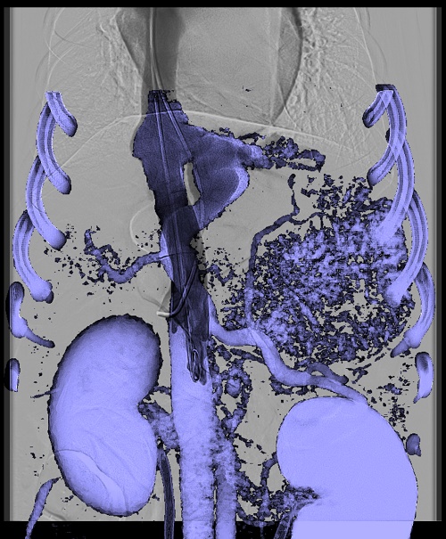A dog undergoing coil embolization of a liver portocaval shunt using CT fusion and 3-D roadmap. (Photo Credit: Brian Scansen)