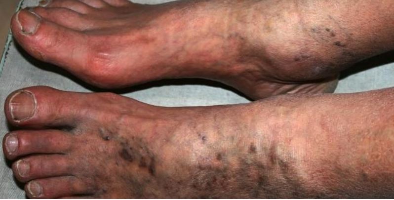 COVID-19: TCTMD’s Daily Dispatch for July 24