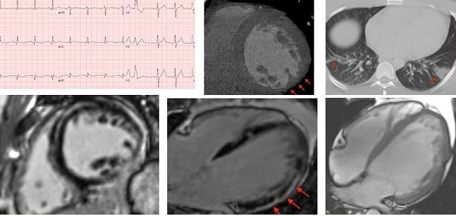 COVID-19: TCTMD’s Daily Dispatch for July 27