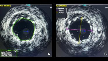 Intravascular Imaging Lowers Risk of MACE at 1 Year in Left Main PCI