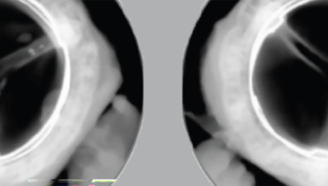 Solid Durability Seen With Surgical Resilia Tissue Aortic Valve 