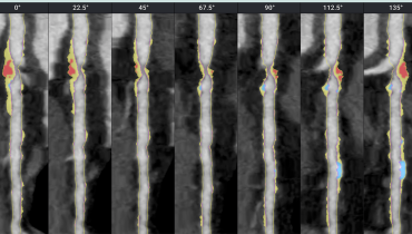 AI-QCT Possibly Lessens Gap Between Ideal vs Actual Care for Patients at Risk of ASCVD