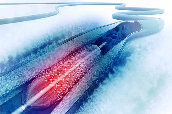 DES With Biodegradable Polymers Stand Up Well Against Durable-Polymer Stents in the Short Term