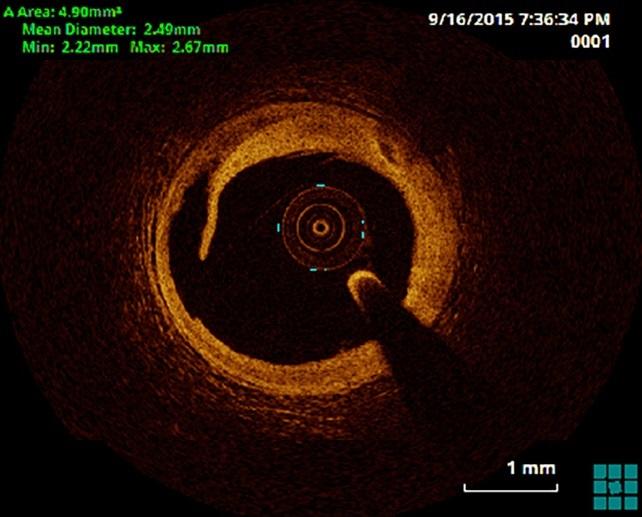 ILUMIEN III: OCT Imaging Matches IVUS but Fails To Beat Angiography for Stent Guidance in PCI