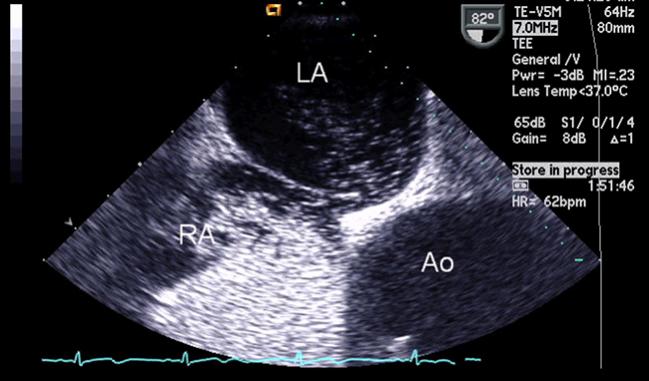 Final RESPECT Data Support PFO Closure for Cryptogenic Stroke Prevention