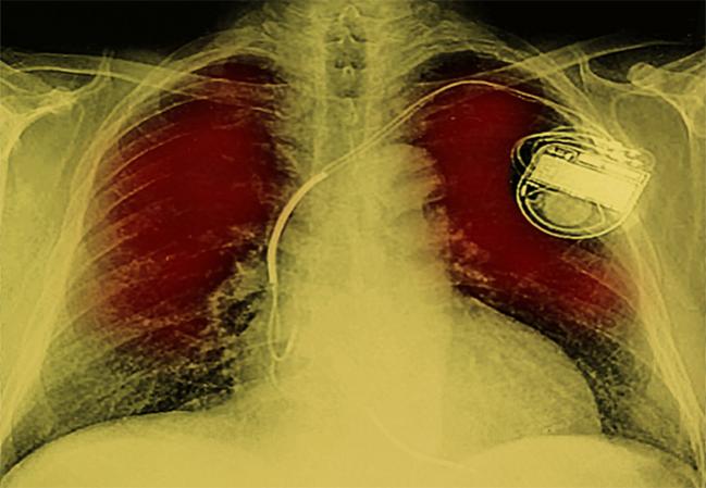 Conduction Problems Requiring Permanent Pacemakers Continue to Vex TAVR Field