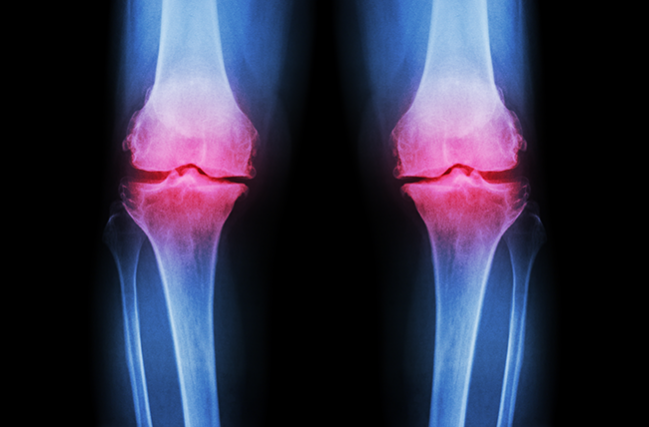 Cardiovascular Safety Differences for COX-2 Inhibitor vs NSAIDs in PRECISION