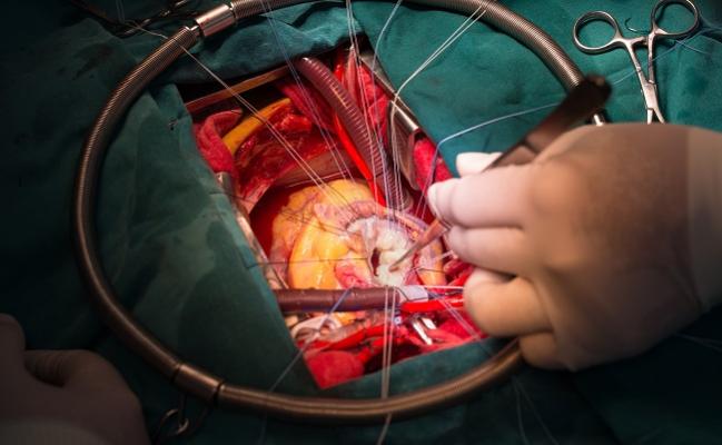 Believe It: Mitral Valve Repair Beats Replacement for Severe Regurgitation, Registry Shows