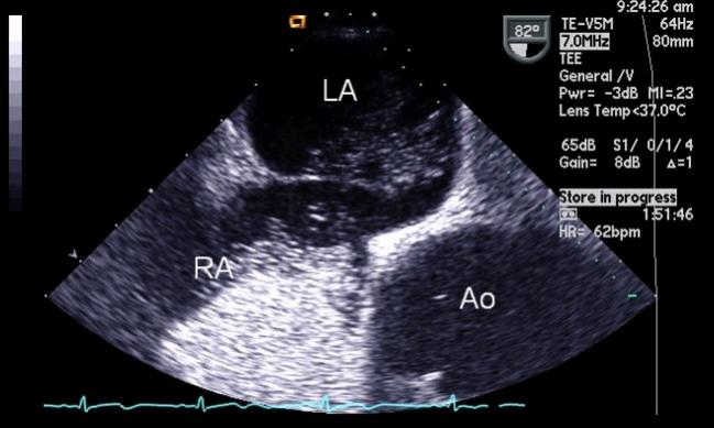 PFO and Migraine? New Study Zeros in on Atrial Septal Aneurysms